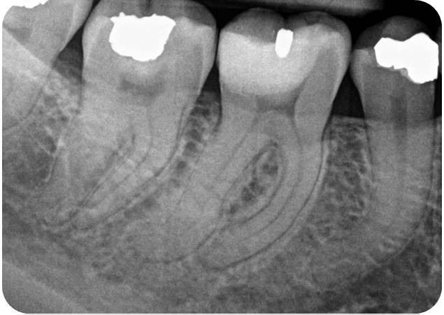 Through Cast Restoration - Case 8