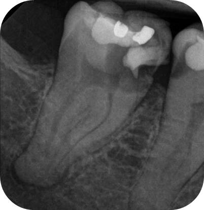 Through Cast Restoration - Case 9