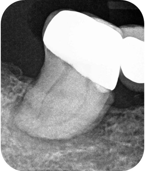 Through Crown And Bridge - Case 1