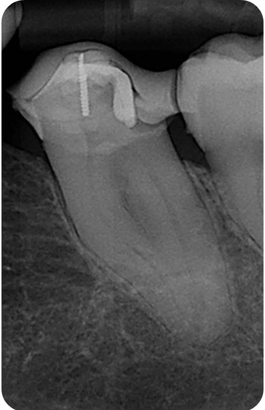 Under Curved Canals And Primary Treatments - Case 1
